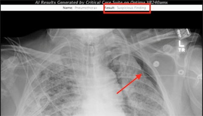 An AI algorithm developed by UCSF researchers identified a pneumothorax in a recent intensive care unit patient. The red annotations were added manually to highlight the finding. Image courtesy of Dr. John Mongan, PhD, and UCSF.