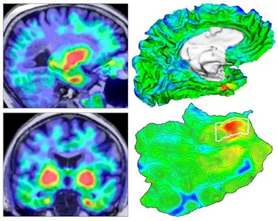 Four views of the origin of tauopathy in vivo. (Left) Tau PET images for a cognitively normal person. (Top right) 3D rendering of brain surface with tau PET overlay. (Bottom right) Flat map showing topographic detail of surface anatomy with tau origin identified in white outline. Images and caption courtesy of Justin Sanchez and Dr. Keith Johnson of MGH.