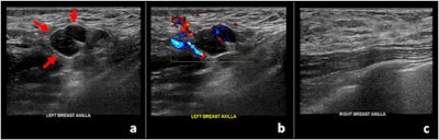 Ultrasound images of a 42-year-old patient who presented for sonographic follow-up of probably benign bilateral breast masses. The patient had received the first dose of the Moderna vaccine in her left arm 13 days prior to imaging. (a) Gray-scale and (b) color Doppler images of an enlarged left axillary lymph node. (c) Unremarkable right axilla.