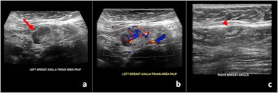 Ultrasound images of a 59-year-old patient who found a palpable lump nine days after receiving the first dose of the Pfizer-BioNTech vaccine in her left arm. (a) Gray-scale and (b) color Doppler images of an enlarged left axillary lymph node. (c) Normal right axillary lymph node. All images courtesy of Dr. Nishi Mehta / Clinical Imaging.