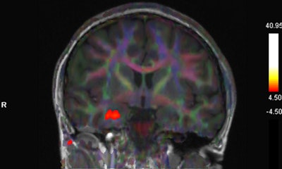 Fused BOLD and fractional anisotropy map on coronal T1-weighted image shows activation of the right uncus/piriform cortex with intact, symmetric architecture of surrounding white-matter tracts.