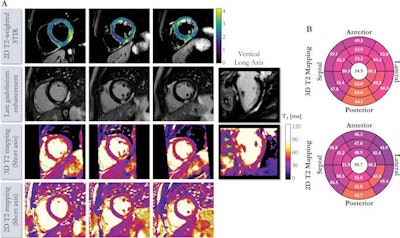 (A) Cardiac MRI scans of a 41-year-old male with suspected cardiac sarcoidosis. Free-breathing 3D whole-heart T2 mapping acquisition time was six minutes and eight seconds. Cardiac cine acquisitions reveal slightly reduced left ventricular ejection fraction (46%). Dense epicardial-to-midwall enhancement of basal to midinferior and lateral walls can be observed, which are typical findings of acute myocarditis. Vertical long axis demonstrates patchy focal midwall regions of enhancement (arrows). (B) 3D and 2D T2 maps. 2D map shows an increase in T2 values (msec) in regions of tissue injury, corresponding to elevation in signal intensity on 2D T2-weighted short inversion time inversion recovery (signal intensity, 2.1). This T2 elevation is less pronounced and appreciable on 2D T2 maps because of partial-volume effects. Image and caption courtesy of Radiology.