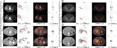 Representative examples of lesions in the same patients scanned at one hour postinjection and three hours postinjection