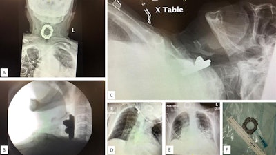 (A) Anteroposterior chest radiograph displaying a spinning top toy in the woman's hypopharynx. (B) Upright lateral neck radiograph. (C) Supine lateral neck radiograph. (D) Wide-angle anteroposterior neck radiograph. (E) Wide-angle anteroposterior neck radiograph. (F) Extracted toy with 3-cm diameter. Images courtesy of Dr. David Gerth. Licensed under CC BY-NC 4.0.