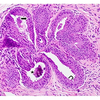 High-power magnification view of characteristic FEA features: (straight arrow) Relatively oval and monotonous nuclei, (hooked arrow) prominent apical snouts, (star) luminal calcifications.