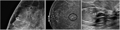 Examples of FEA on abnormal screening mammograms.