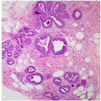 Low-power magnification view of FEA. All images courtesy of the RSNA.