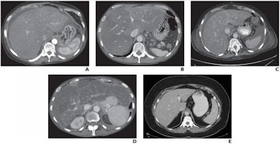 A and B, true-positive assessments in 58-year-old woman (A) and 52-year-old man (B) with high-risk NAFLD and associated NASH. CT images show hepatic enlargement, heterogeneously low-attenuation hepatic parenchyma, and surrounding ascites. Readers correctly identified NASH according to these imaging features. Readers also correctly identified fibrosis stage F3. C and D, False-positive assessments in a 73-year-old woman (C) and a 61-year-old woman (D) with high-risk NAFLD but without pathologic evidence of NASH. CT images show findings similar to A and B. Readers incorrectly identified NASH because of these imaging findings but correctly identified fibrosis stages F3 (C) and F4 (D). E, False-negative assessment in a 56-year-old woman. CT image shows liver is not enlarged, heterogeneous, or low in attenuation, and ascites is not present. Both readers interpreted the image as not showing findings indicative of NASH. However, NASH was diagnosed from surgical pathology. Image courtesy of American Roentgen Ray Society, American Journal of Roentgenology.