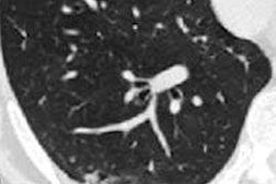 2021 01 27 20 12 5362 2021 01 28 Chest Ct Lung Damage Post Covid Figure2 20210127201514