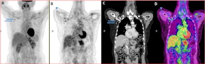 FDG PET/CT scan. (A) Maximum intensity projection. (B) Coronal multiplanar reconstruction. (C) CT. (D) Fusion. PET scan shows focally increased uptake in the right deltoid muscle (arrowhead) and moderately increased uptake in two right axillary lymph nodes of normal size (arrows), corresponding with recent COVID-19 vaccination. Image and caption courtesy of the RSNA.