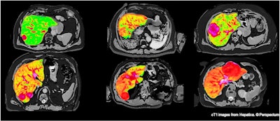 Hepatica is a precision oncology decision-support tool for liver cancer. Image courtesy of Perspectum.