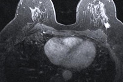 2020 02 25 00 02 3958 Mri Breast Cancer 20200225002942