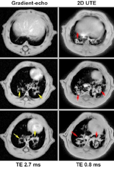 Development of ultrashort echo time (UTE) MRI for imaging the lung in small rodents increased significantly the sensitivity for detecting pathology in a shorter acquisition time. A bleomycin (BLM) model of pulmonary fibrosis illustrates this well. Two-dimensional multislice gradient-echo and UTE acquisitions performed at 4.7 tesla on the same rat, at day 15 after BLM (4 mg/kg) administration. Image slices have the same geometrical parameters and positions for both acquisitions. It is clear that UTE allowed a more accurate detection of pathology reflecting tissue remodeling and fibrosis.