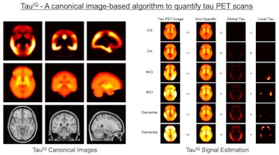 TauIQ provides quantitative analysis of tau PET biomarker data in Alzheimer's disease. Image courtesy of Invicro.