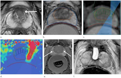 Images in a 69-year-old man with biopsy-confirmed prostate cancer classified as Gleason score 7 (3 + 4). (a) Pretreatment axial T2-weighted fast spin-echo MRI scan shows tumor in midline anterior transition zone (arrow). (b) Intraoperative MRI scan shows contoured rectal wall (red line), prostate margin (blue outline), and region of interest (orange outline). Because the urethra was included in the planned treatment volume, a suprapubic catheter was placed for continuous bladder drainage during treatment. (c) Intraoperative MRI scan shows focused ultrasound beam path (blue) overlaid on the treatment plan. Rectangles illustrate each sonication spot. (d) Thermal map image obtained during treatment with heat deposition color-coded in red overlaid on sonication spot. (e) Axial contrast-enhanced MRI scan obtained immediately after treatment shows devascularized ablated volume (arrows). (f) Corresponding T2-weighted fast spin-echo MRI scan at 5 months after ablation shows complete involution of the transition zone. All seven cores from treatment area margins were negative for cancer at biopsy. Images and caption courtesy of RSNA.