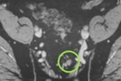 2021 02 04 20 55 8044 2021 02 05 Nano Mri Psma Pet Ct Prostate Cancer 20210204205609