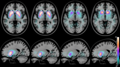 SPECT images, superimposed on an MR atlas, of an axial slice (top row) and a sagittal slice (bottom row) of the human brain, with a quantitative artificial-color scale showing the differences in the average distribution of the radioactive compound [I-123] FP-CIT in the striatum of healthy controls, Alzheimer's disease, dementia with Lewy bodies, and Parkinson's disease (from left to right). Images courtesy of Francisco Oliveira and the Champalimaud Centre for the Unknown.