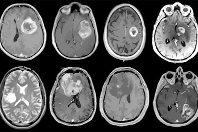 MRI scans of eight patients with glioblastoma. A new study led by Washington University School of Medicine in St. Louis has detailed molecular and genetic schematics of these tumors, which could improve treatment therapies. Images courtesy of coauthor Dr. Albert Kim, PhD, of Washington University in St. Louis, MO.