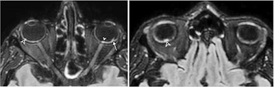 A 56-year-old man presenting with severe COVID-19. The patient had been hospitalized in the ICU for 20 days when an MRI was performed due to delayed awakening despite discontinuation of sedation. He presented with acute respiratory distress syndrome and was intubated on high-flow supplementary oxygen and placed in the prone position. 3D fluid-attenuated inversion recovery-weighted MRI reformatted in the axial plane shows several hyperintense nodules of the posterior pole of the globe located in the macular region (white arrowhead) and the extramacular region (black arrowheads). Note the presence of a focal temporal retinal detachment of the left eye (arrow). Images and caption courtesy of the RSNA.