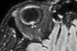 2021 02 12 22 43 3372 2021 02 16 Mri Covid Eye Complications Figure2 20210212224548