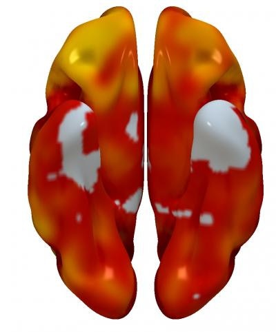 3D reconstructions of superior (left) and inferior (right) brain regions, showing regions with lower metabolism associated with the presence of atherosclerotic plaques in the carotid arteries. The color code indicates the magnitude of the observation (yellow, strong association; red, lower association). Gray indicates areas showing no association with carotid plaque presence. Image courtesy of Centro Nacional de Investigaciones Cardiovasculares (CNIC).