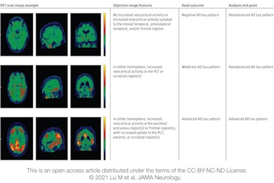Image displays categories used in the visual interpretation of flortaucipir PET scans. Three cases represent the three levels of visual reads and corresponding analysis end-point calculation. Image courtesy of JAMA Neurology.