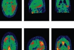 2021 02 16 23 38 3157 2021 02 16 Pet Alzheimers Jama Neuro 20210216233510