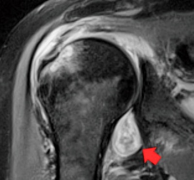 MRI image of a patient's shoulder. The red arrow points to inflammation in the joint. The COVID-19 virus triggered rheumatoid arthritis in this patient with prolonged shoulder pain after other COVID-19 symptoms resolved. Image courtesy of Northwestern University.