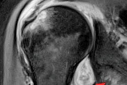 2021 02 17 22 24 2554 2021 02 18 Mri Shoulder Post Covid 20210217224521