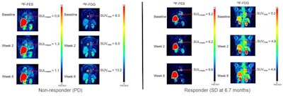 F-18 FES PET images of patients with estrogen receptor positive, progesterone receptor positive, HER2 negative invasive ductal carcinoma. Left panel: Progressive disease seen at the eight-week time point in a patient on sequential therapy. Right panel: Stable disease through all three time points, remaining on study therapy for 6.7 months until disease progression on combined vorinostat aromatase inhibitor therapy. Image courtesy of Lanell M. Petersen, research scientist at the University of Washington Medical Oncology in Seattle.