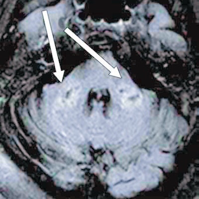 Axial fluid-attenuated inversion-recovery MR image shows T2 prolongation in bilateral middle cerebellar peduncles (arrows). Findings were associated with restricted diffusion and areas of T1 hypointense signal without enhancement or abnormal susceptibility. Image and caption courtesy of the American Roentgen Ray Society (ARRS) and the American Journal of Roentgenology (AJR).