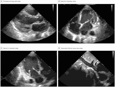 Still images of standard transthoracic echocardiographic views acquired by a nurse using the deep-learning algorithm were judged to be of diagnostic quality. Image courtesy of Caption Health.