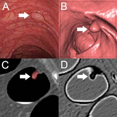 (A) Optical colonoscopy and (B-D) CT colonography of a 9-mm polyp (arrow) in the descending colon of a 78-year-old woman. (B) Virtual fly-through 3D reconstructions were used for exact polyp localization. (C) Manual polyp segmentation was performed in multiplanar 2D CT colonography images. (D) CT colonography images were preprocessed for image feature extraction by application of a dedicated filter. Image and caption courtesy of the RSNA.