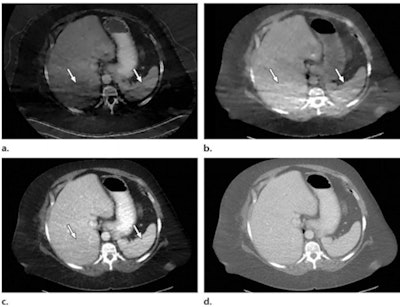 Photon starvation in a large patient. Axial portovenous-phase abdominopelvic CT was performed in a 242-lb patient using rapid kilovolt peak (kVp) switching DECT. (a) Material density iodine image shows dark bands of artifact (arrows) across the liver and spleen. (b) On an MD-water image, the streaks appear as bright bands (arrows). (c) On a 65 kilo-electron volt (keV) image, the artifacts are much less apparent (arrows). (d) On a 140 kVp-equivalent image, the artifacts are not visualized. Images and caption courtesy of the RSNA.