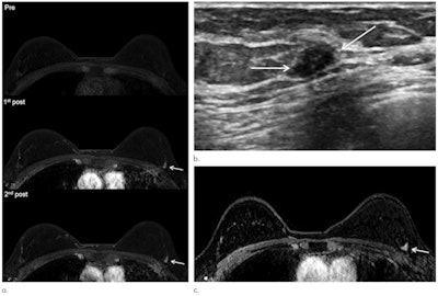 Representative images of cancer missed at MRI in a 46-year-old woman with a personal history of breast cancer. (a) Retrospectively reviewed abbreviated breast MRI (axial precontrast, first and second postcontrast images) shows a 0.7-cm mass (arrows) in the periphery of the left breast at the 2-o'clock position. At that time, a radiologist mistook the mass as normal background parenchymal enhancement, and it was assessed as Breast Imaging Reporting and Data System (BI-RADS) category 2 on MRI report. (b) After eight months, screening ultrasound image shows 1-cm irregular hypoechoic mass (arrows). Ultrasound-guided core-needle biopsy yielded invasive ductal carcinoma. (c) At preoperative staging MRI, which was performed eight months after abbreviated MRI, mass grew to 1-cm irregular enhancing mass (arrow). Subsequent surgery revealed 1.1-cm invasive ductal carcinoma with 2-cm ductal carcinoma in situ that was intermediate grade, hormone receptor-positive, and human epidermal growth factor receptor 2 negative. Images and caption courtesy of the RSNA.