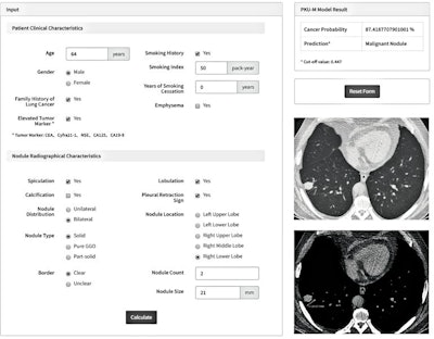Screenshot of the web-based PKU-M model's analysis of a 64-year-old male patient with a family history of lung cancer, a 50-pack-year smoking history, and an elevated carcinoembryonic antigen value. An incidental thoracic CT scan discovered two nodules scattered bilaterally in the lung. The nodule located in the right lower lobe was 21 mm and presented spiculation, lobulation, the pleural retraction sign, and the solid type. The predicted probability of cancer by the PKU-M model was 87.4%. After surgical resection, pathologic examination confirmed squamous cell carcinoma. Image and caption courtesy of Clinical Cancer Research.