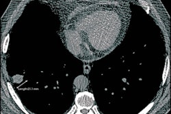 2021 02 24 20 57 2347 2021 02 24 Ai Lung Nodules 400