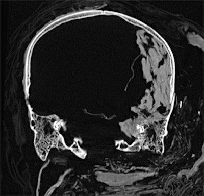 Coronal CT image of the head and neck of the mummy of Seqenenre Taa II. The desiccated brain is seen shifted and occupying the left side of the cranial cavity. All images courtesy of Dr. Sahar Saleem and Frontiers in Medicine.