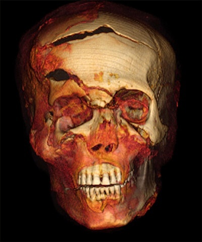 3D CT image of head of Seqenenre in frontal projection showing multiple craniofacial injuries: a gaping fracture of the frontal bone; fracture above the right eyebrow; comminuted fractures of the nose, right orbit, and right zygoma caused by blunt trauma; and a small perforating wound overlying the right cheek caused by fragments of the fractured zygoma.