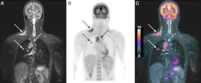 Coronal short tau inversion-recovery (STIR) (A), FDG-PET (B), and FDG-PET/MRI (C) fused images show how the hybrid modality detected right supraclavicular fossa and right paratracheal lymphadenopathy, as well as a right lung nodule (arrows), in a 14-year-old male with Hodgkin lymphoma. Images courtesy of the Journal of Nuclear Medicine.