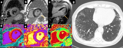 Myocarditis. 51-year-old man hospitalized for COVID‐19 pneumonia and sudden onset of tachyarrhythmias. short tau inversion recovery images revealed no edema (a), although late gadolinium enhancement (LGE) was evident on inferolateral segments of basal-mid planes with a subepicardial pattern of distribution (b, c: orange arrows) and native T1 was increased on LGE + segments (d). T2 mapping sequences revealed the presence of edema on inferolateral segments of mid-ventricular planes (e). Extracellular volume confirmed those findings with implemented values on inferolateral wall (f). Chest CT showed ground glass opacity predominantly distributed on inferior lobes with a peripheral distribution (g). All images courtesy of Dr. Federica Catapano; Marco Francone, PhD; and Insights into Imaging.