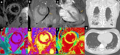 Pericarditis. 36-year-old in-hospital COVID-19 patient with chest discomfort and evidence of pericardial effusion at bedside echocardiography. In (a), there is evidence of slight hyperintensity of the pericardial layers, with no myocardial edema. LGE sequences confirm presence of pericardial layers enhancement and moderate pericardial effusion (b, c: orange arrows). Native T1 values were mildly increased (d) as well as T2 mapping (e) and extracellular volume values (f). Coronal and axial chest CT revealed peripheral posterior areas of parenchymal consolidation (g).