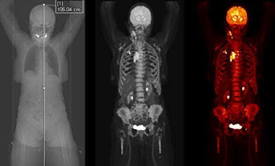 Biograph Quadra Vision can cover more patient anatomy in a single bed position than a standard PET/CT scanner. Image courtesy of Siemens Healthineers.