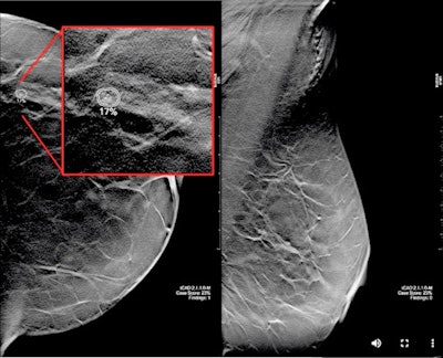 A 59-year-old woman with scattered density breasts. The lesion is only seen on the tomosynthesis slices. The case was not triaged at the 0 false-negative rate, however, as researchers increased the false-negative rate to 0.12 per 1,000 women screened; the AI software would have characterized this as a small invasive ductal carcinoma. Image courtesy of Dr. Emily Conant.