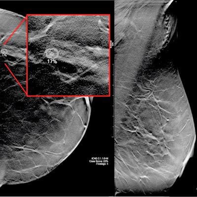 Breast cancer detection: advantage DBT •