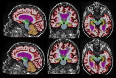 Accelerated Scan Mri AI-based reconstruction speeds up quantitative volumetric MRI | AuntMinnie