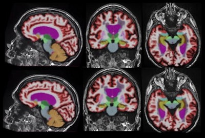 Representative 3D T1-weighted multiplanar images with volumetric segmentation on a 3-tesla scanner. [Left to right]: Sagittal, coronal, and axial T1-weighted images with standard protocols (scan time, five minutes and 44 seconds) on the top row and deep learning-enhanced accelerated imaging (scan time, two minutes and 18 seconds) on bottom row. Images courtesy of Dr. Suzie Bash.