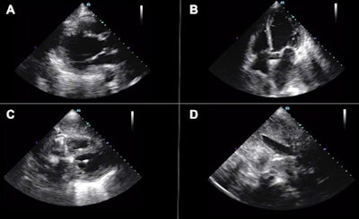 Bedside artificial intelligence-guided cardiac ultrasound revealed new severe left ventricular dysfunction (automated ejection fraction estimated to be 27%) and normal right ventricular function with a noncollapsible inferior vena cava. (A) Parasternal long-axis, (B) apical four-chamber, (C) subcostal four-chamber, and (D) subcostal inferior vena cava views are provided. Image courtesy of JACC Case Reports and Dr. Baljash Cheema, et al. Licensed under CC BY-SA 4.0.