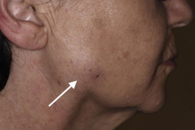 The patient had a hardened, tender swelling near the right angle of the jaw (white arrow). All images courtesy of Becker et al. Licensed under CC BY-NC 4.0.