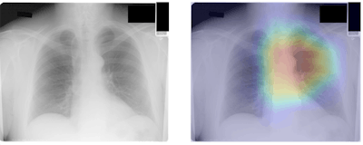 Gradient-weighted class activation maps can localize anatomy contributing to CXR-Age estimates. In this 55-year old man, the CXR-Age model focuses on the aortic knob. Image courtesy of Vineet Raghu, PhD, and Dr. Michael Lu.